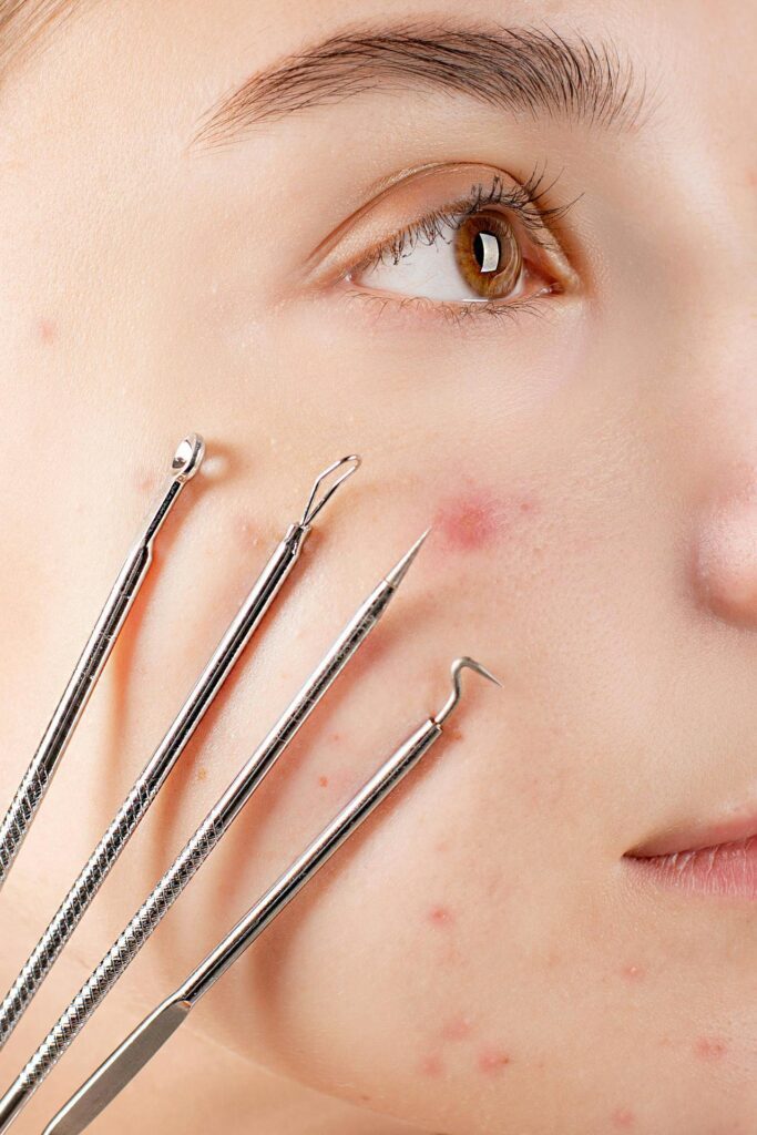 Woman's Face With Four Skin Extractor Tools microneedling